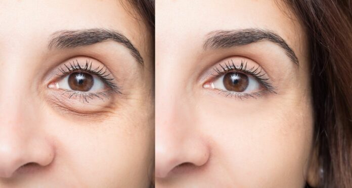 remedies for reduce dark circles and puffy eyes